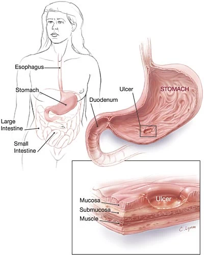 แผลกระเพาะอาหาร
