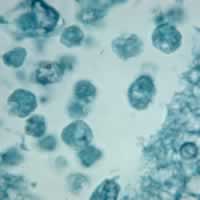 Naegleria fowleri in brain tissue