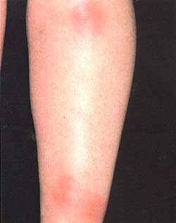 erythema nodusum