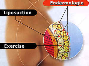 Cellulite Diagram