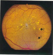 retinopathy