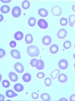 anisocytosis