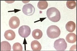 macrocytic