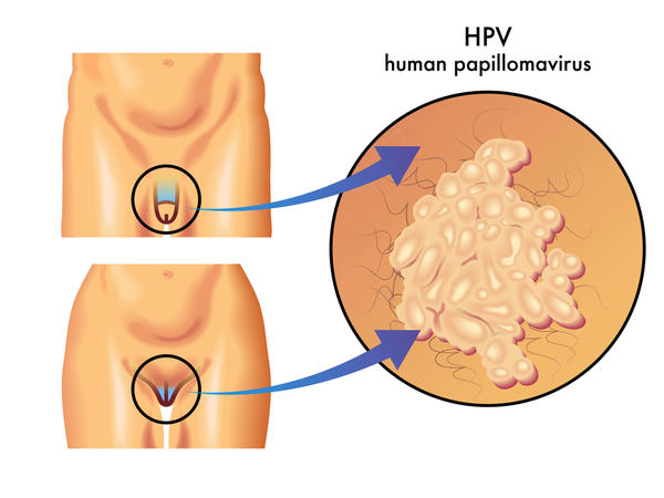 hpv