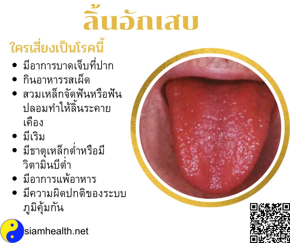 ลิ้นอักเสบ